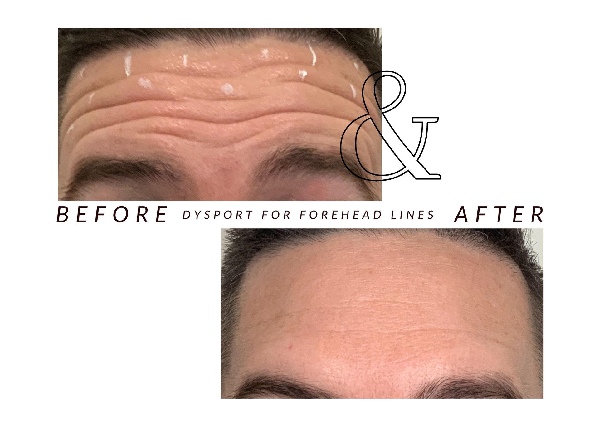 A before and after photo of a man 's forehead lines.