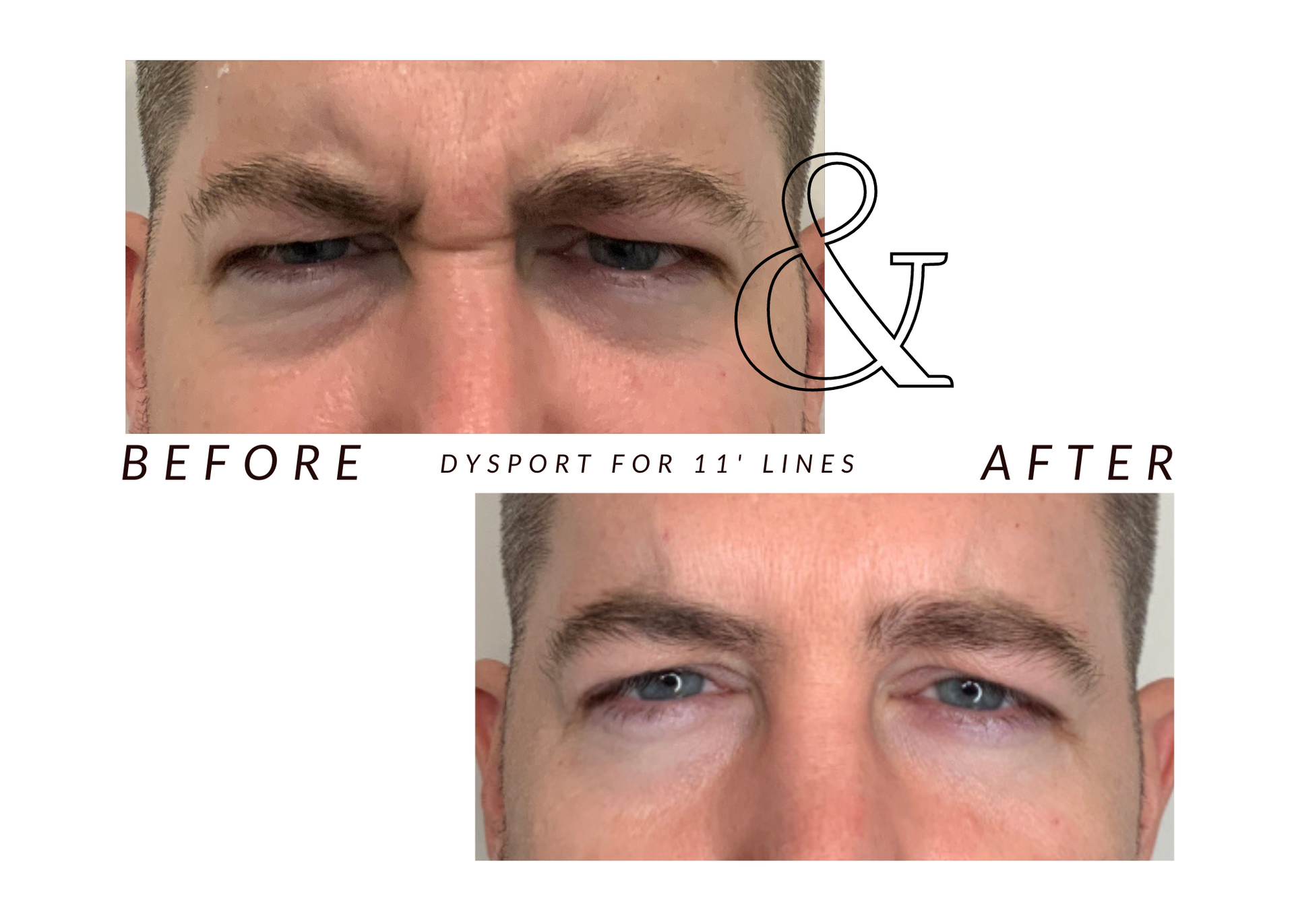 A before and after photo of a man 's forehead.