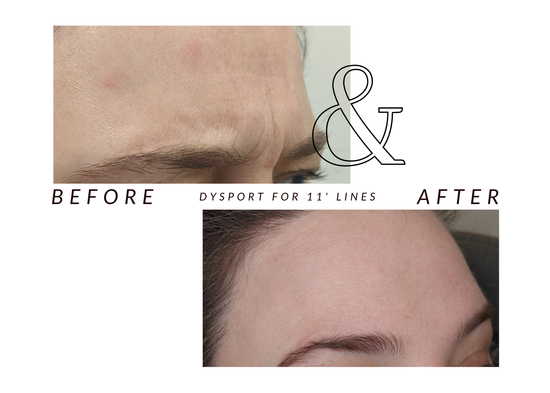 A before and after photo of a woman 's forehead