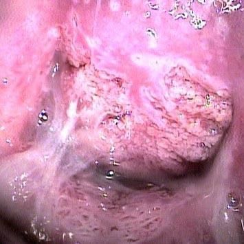 Colposcopia