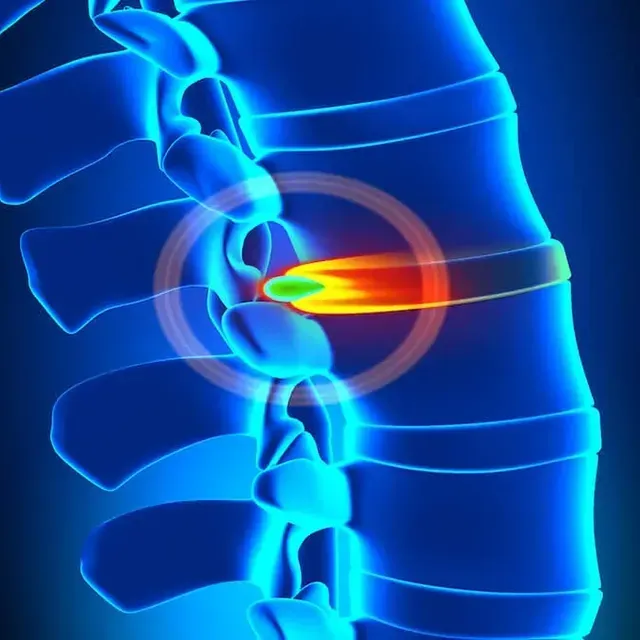 Blue medical illustration of spine with glowing red-orange herniated disc pressing on nerves