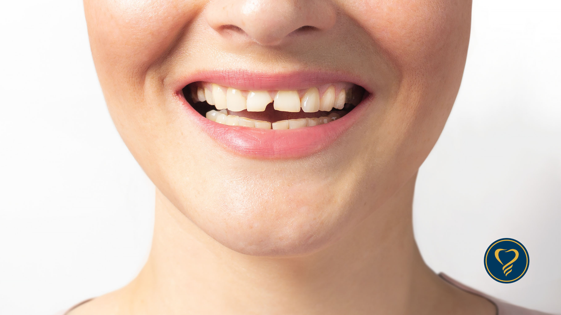 Close-up of a smiling mouth showing a small gap between the two front teeth.