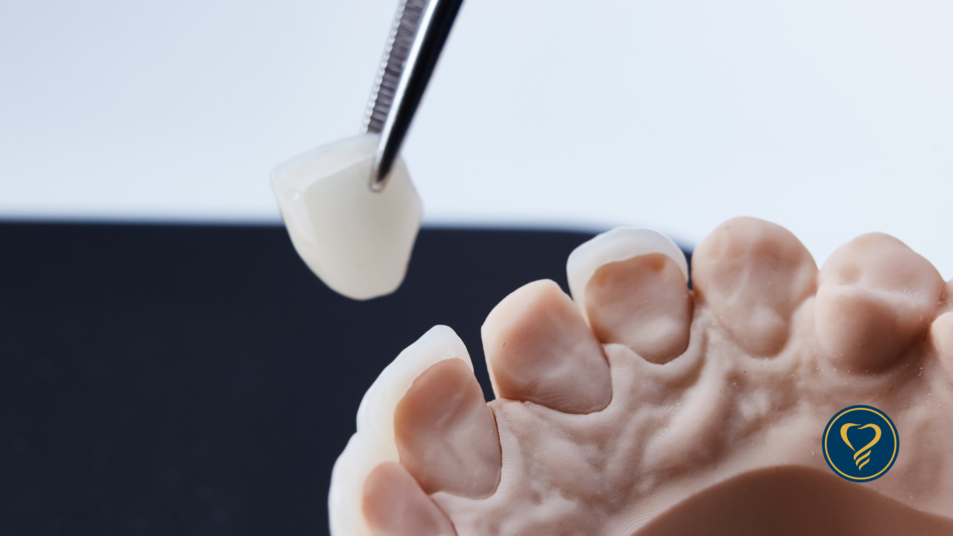 A pair of tweezers holds a dental veneer above a 3D-printed dental model of upper teeth.