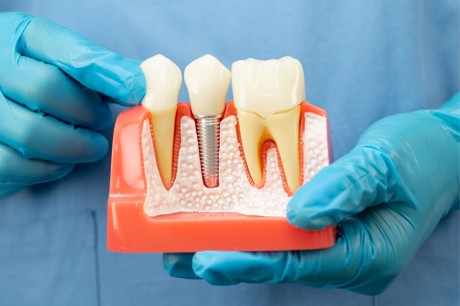 A dentist in blue gloves holds a model of teeth, one with a dental implant, orange gums and white teeth.
