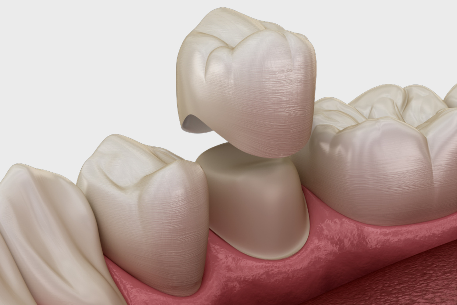 Dental crown being placed on a prepared tooth. Illustration shows the procedure, pink gums, and surrounding teeth.