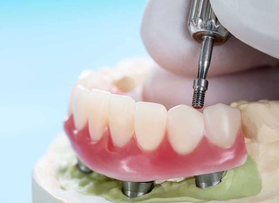 A dentist installing a dental implant on a model of teeth, using a drill.