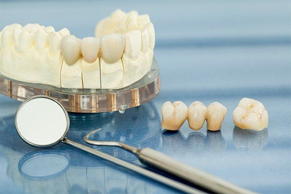 Dental Crowns and Bridges