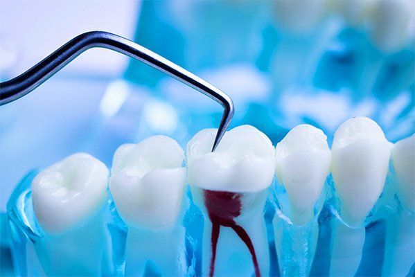 Root Canal Treatment