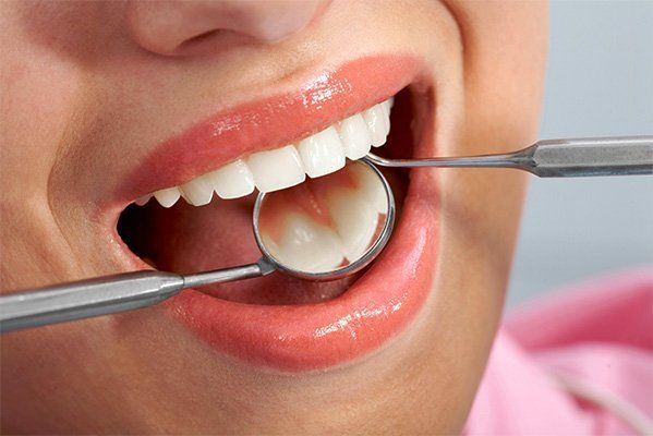 Tooth- Colored Fillings