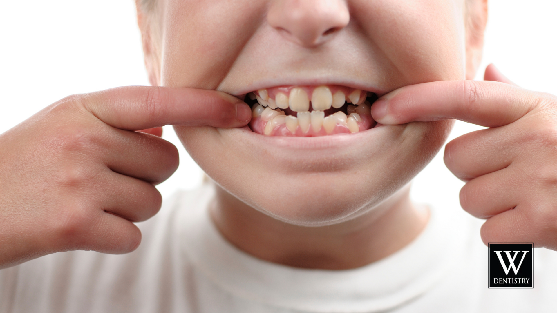 A close up of a person 's mouth with their fingers pointing at their teeth.