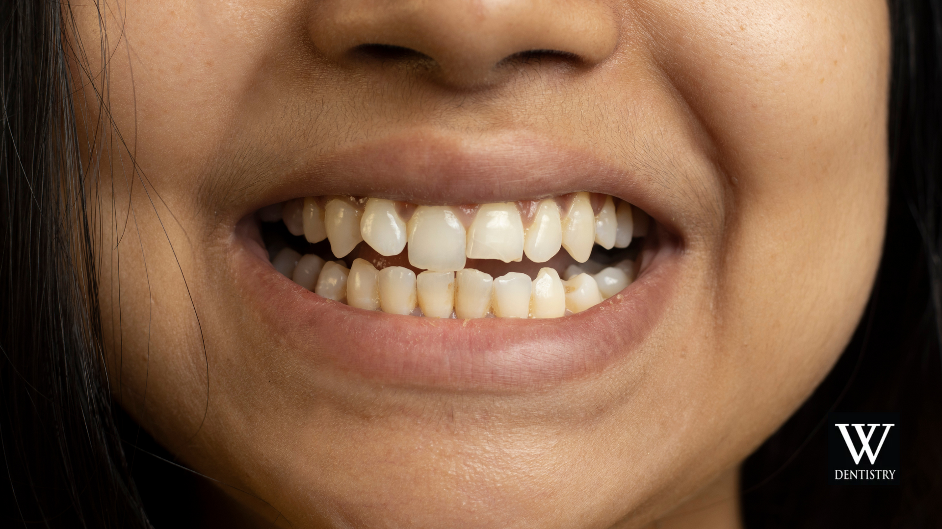 A close up of a woman 's teeth with a missing tooth.