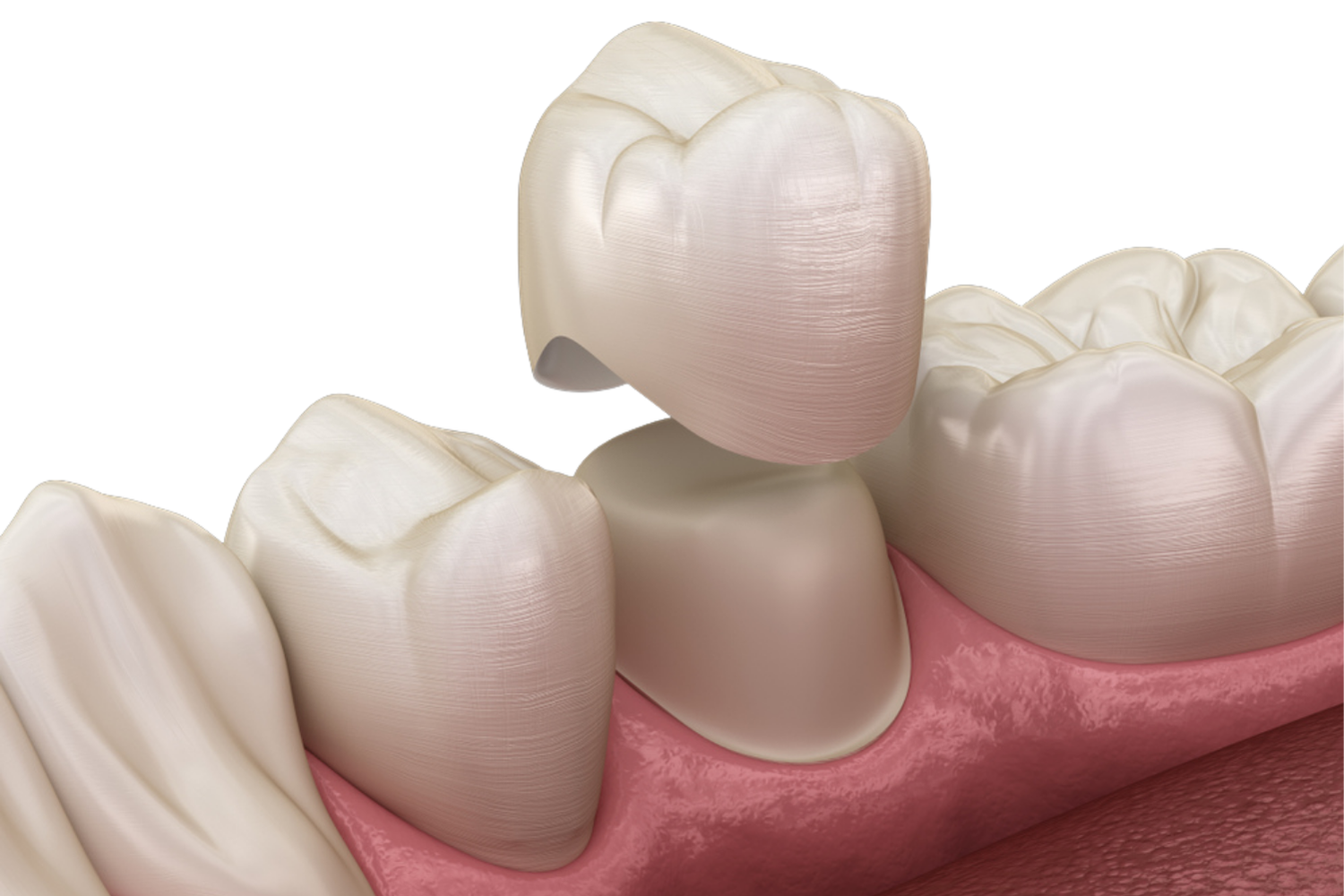 Dental crown being fitted over a tooth in a close-up of gums and teeth.