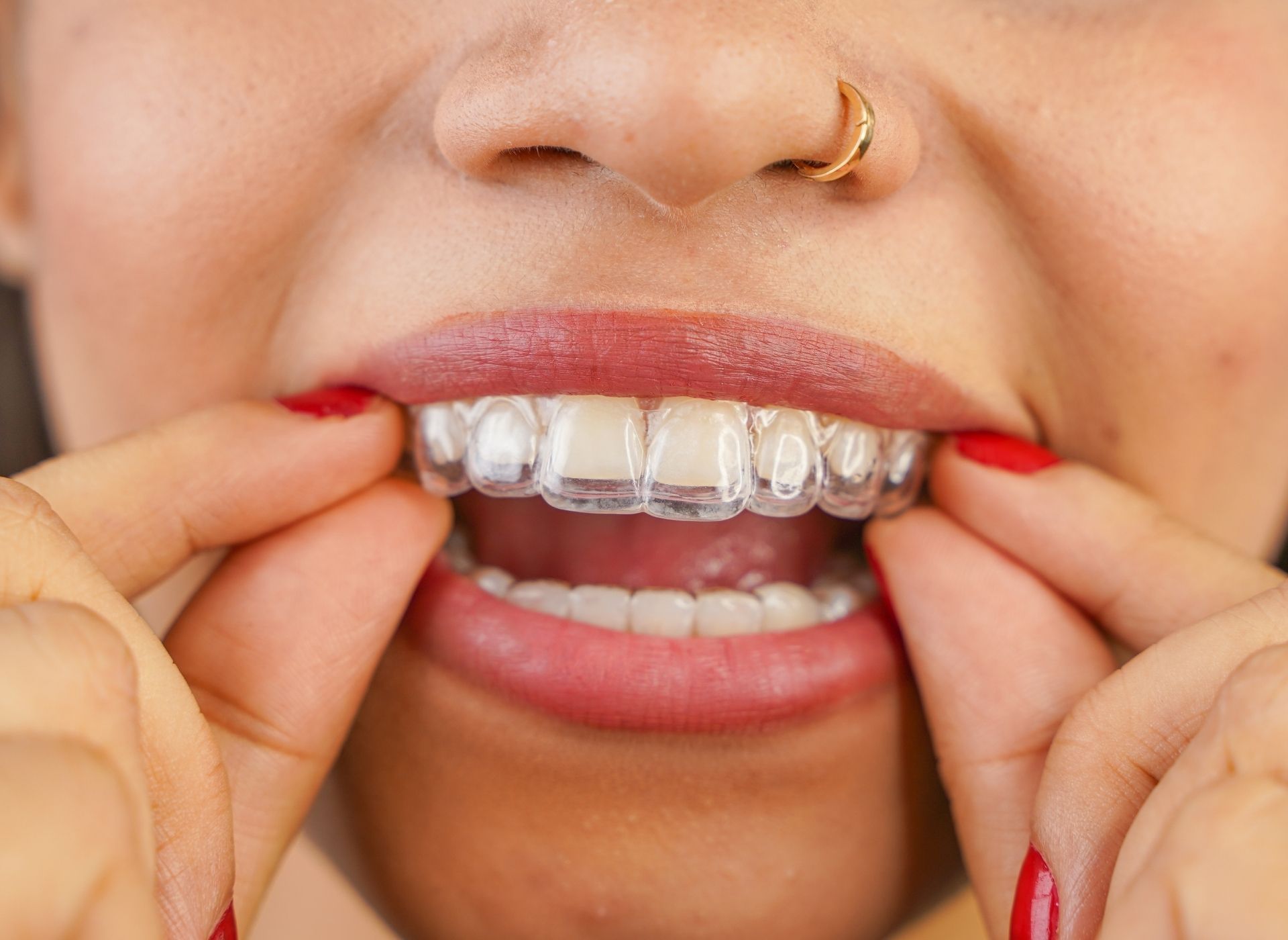 Hands adjusting clear braces on teeth with red-painted nails