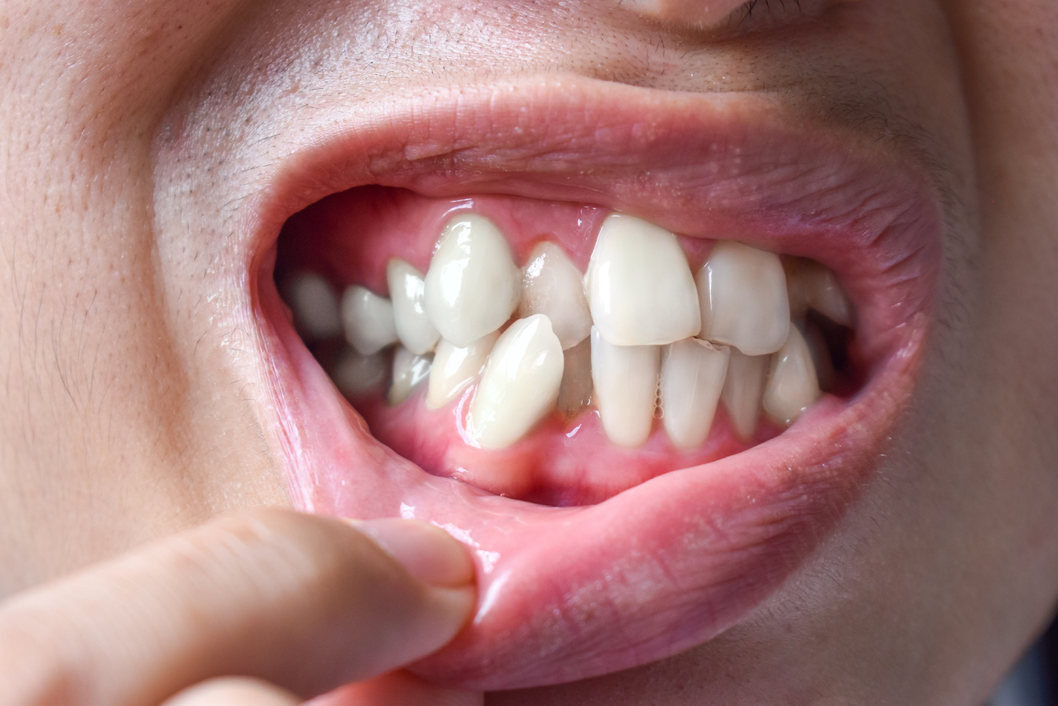 Close-up of a mouth showing crowded, misaligned teeth with a finger pulling down the lower lip