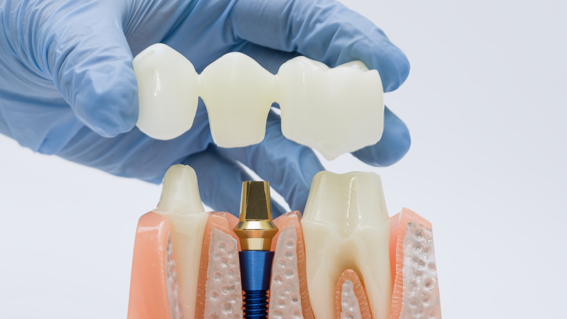 What Should You Do If a Dental Crown Falls Off Suddenly?