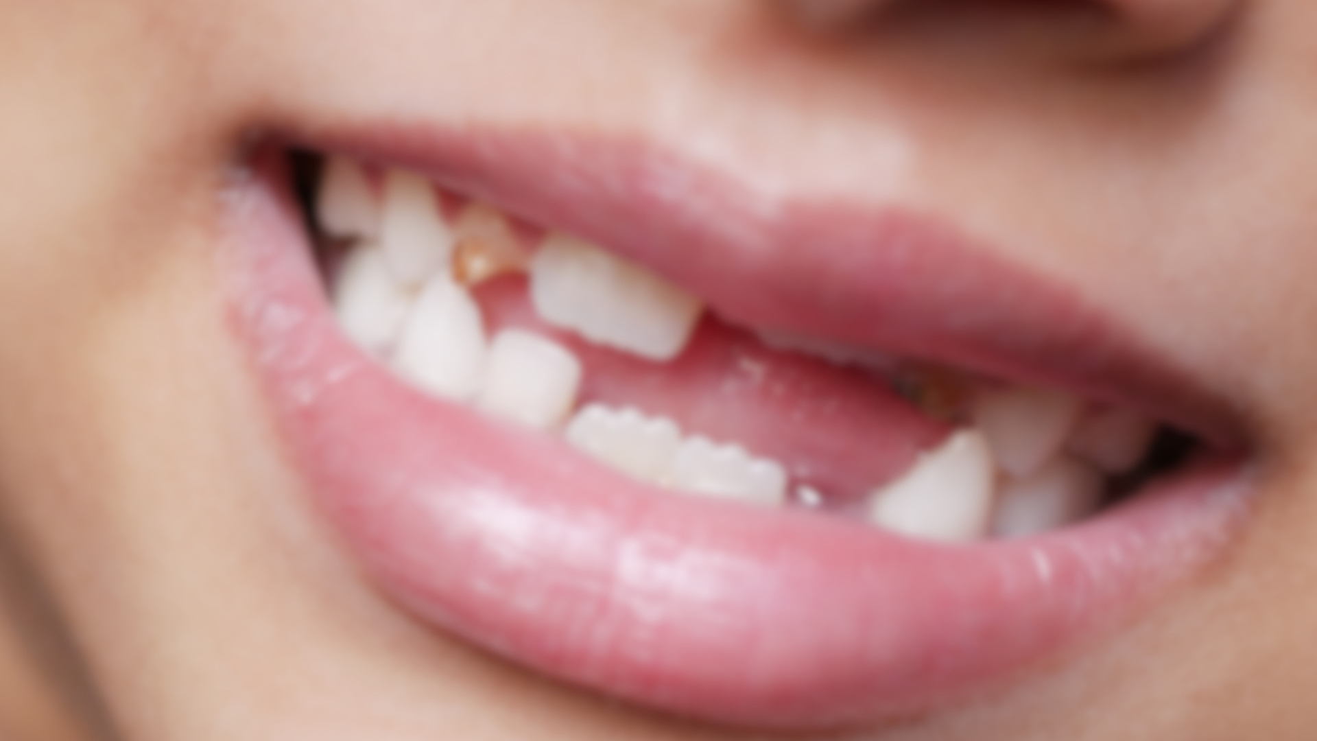 What to Do If You Chip a Tooth but It Doesn’t Hurt