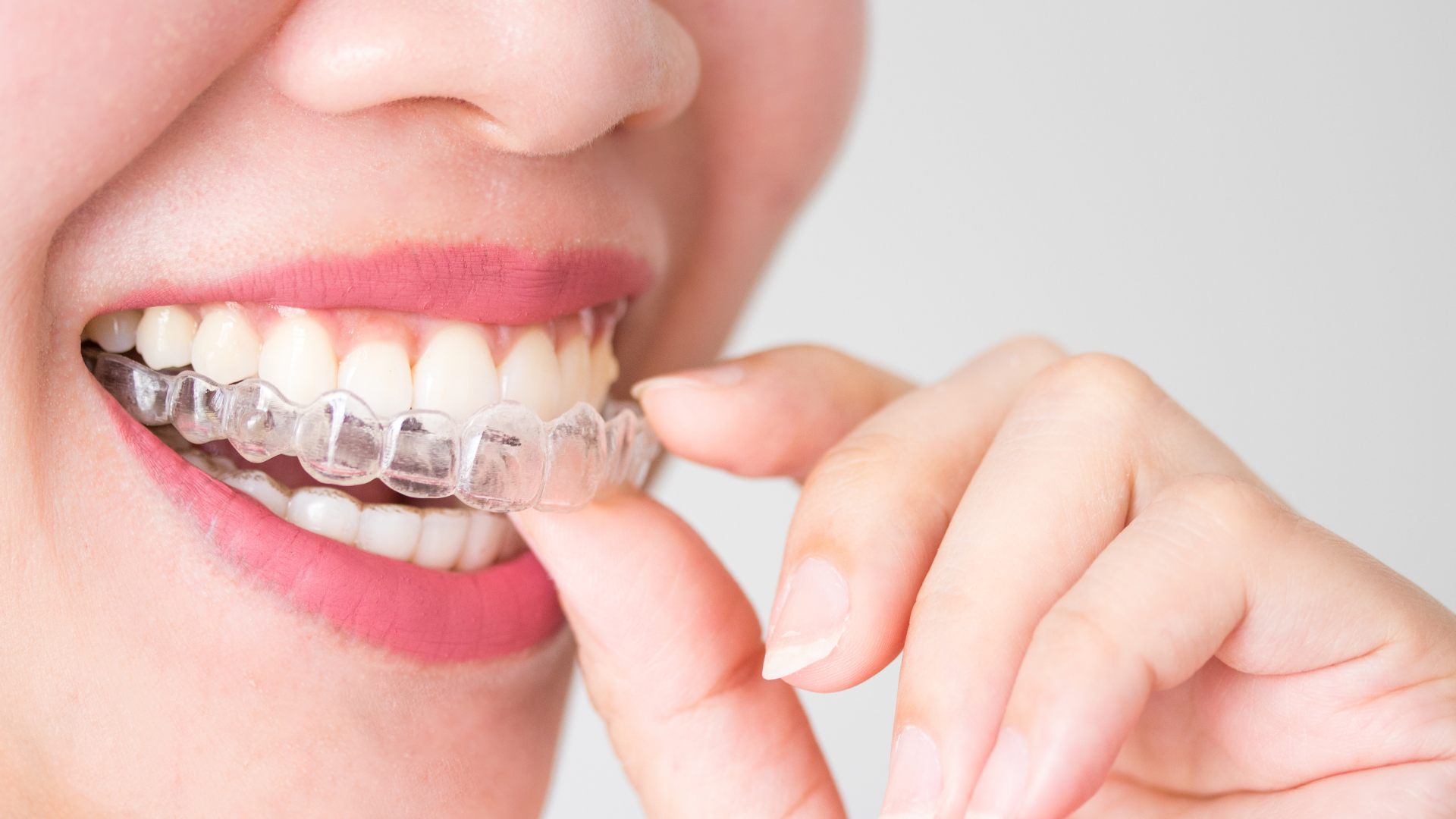 Do SureSmile® Clear Braces Work for Severe Crowding?