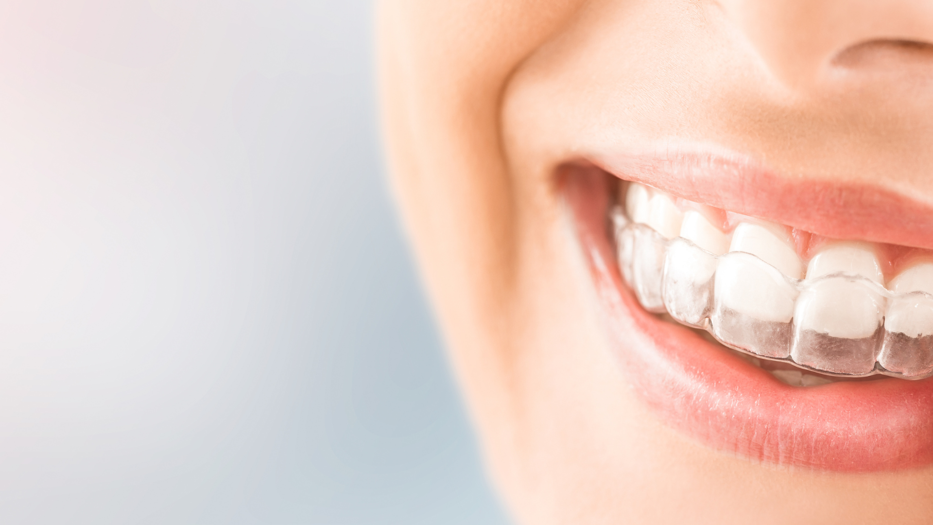 Do SureSmile® Clear Braces Work Faster Than Traditional Braces?