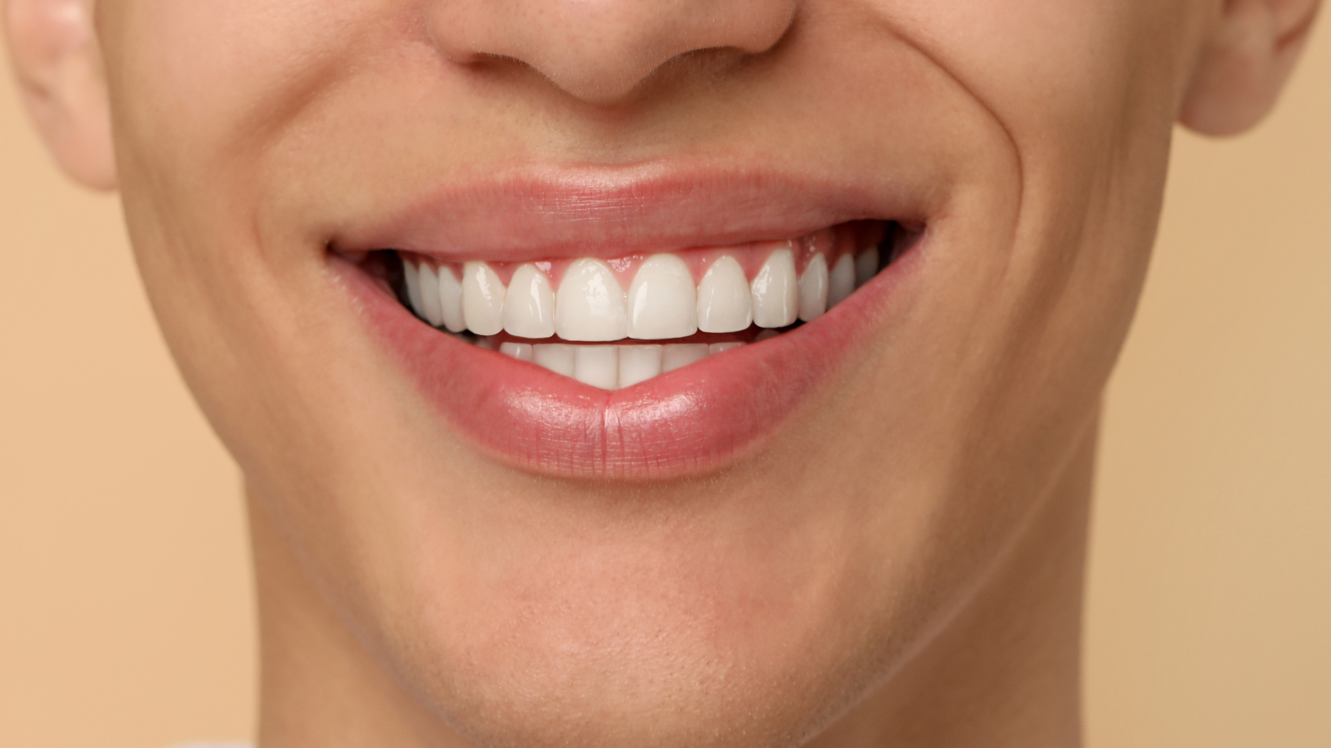 Can Veneers Fix Gaps Between Teeth Without Braces?