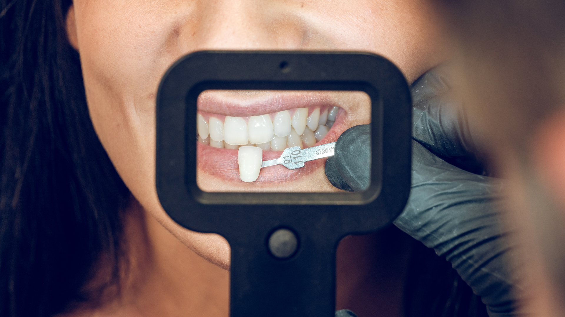 What Foods Should You Avoid With Veneers? A Complete Guide