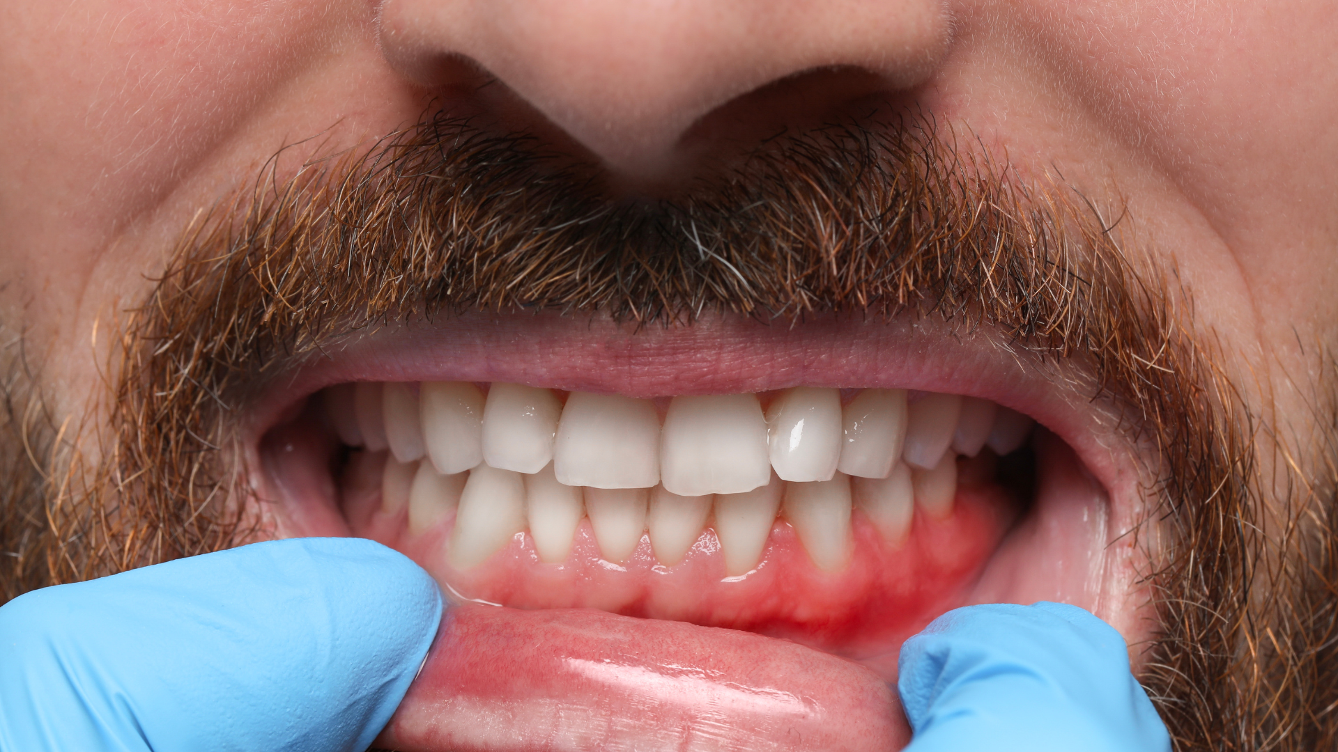 Can Swollen Gums Be an Emergency? When to Seek Immediate Care