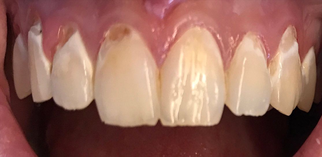 BEFORE