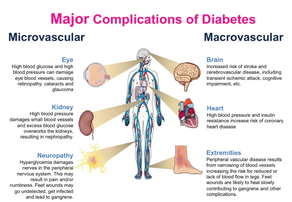 Diagram: Major complications of diabetes affecting eyes, kidneys, brain, heart, and extremities.