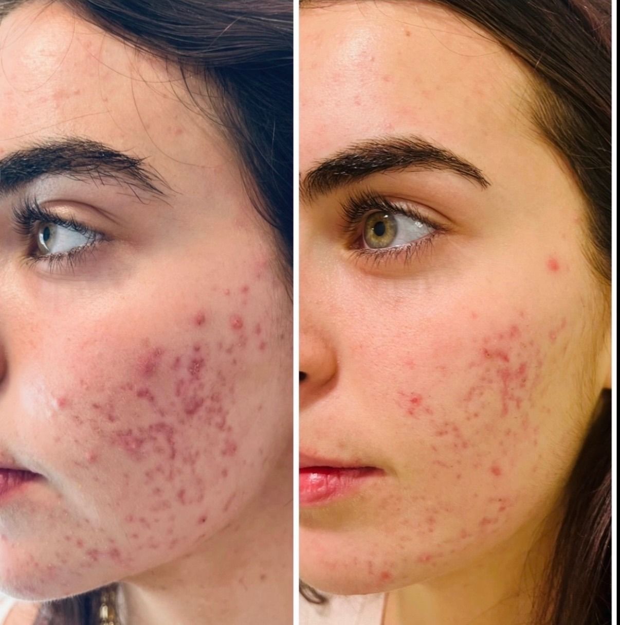 Side-by-side close-up face photos showing acne before and after treatment.