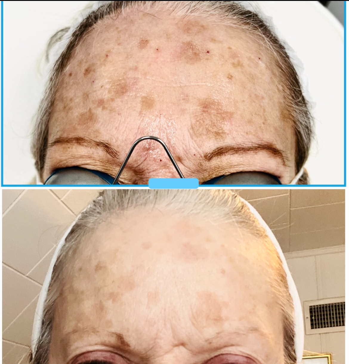 Before-and-after comparison showing a forehead with hyperpigmentation that has visibly lightened after treatment.