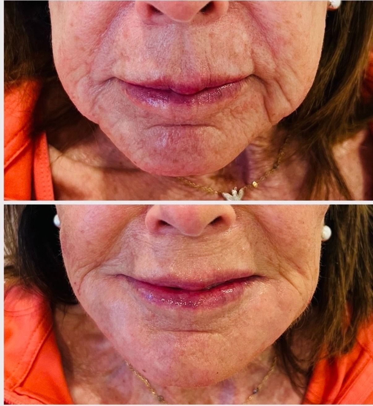 Side-by-side close-up of a lower face, showing a neutral expression before and after treatment.