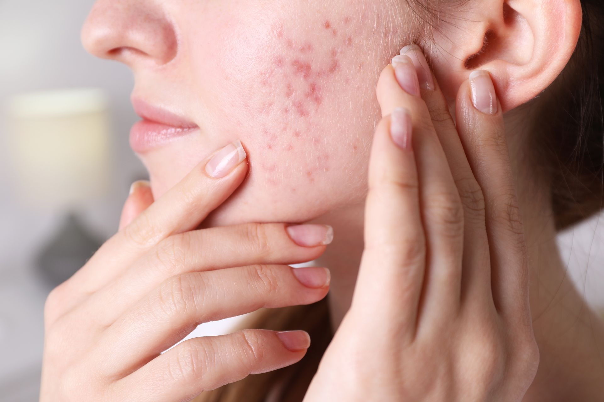 Woman touches cheek with acne.