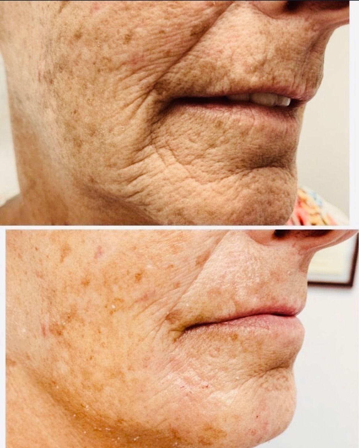 Split close-up of a person’s lower face before and after skin treatment, showing reduced wrinkles and spots