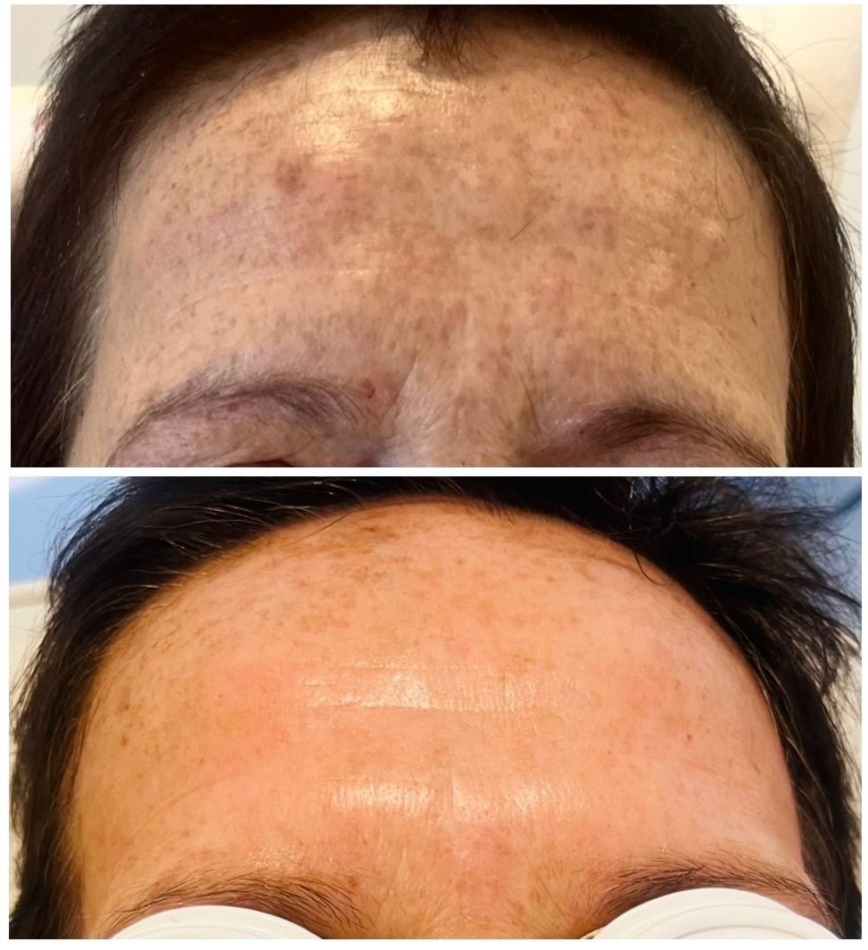 Forehead before-and-after: dark spots and redness above the brows, then smoother, clearer skin
