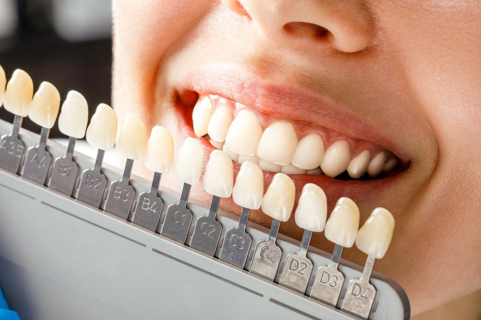 Dental shade guide held to smiling mouth for tooth color matching