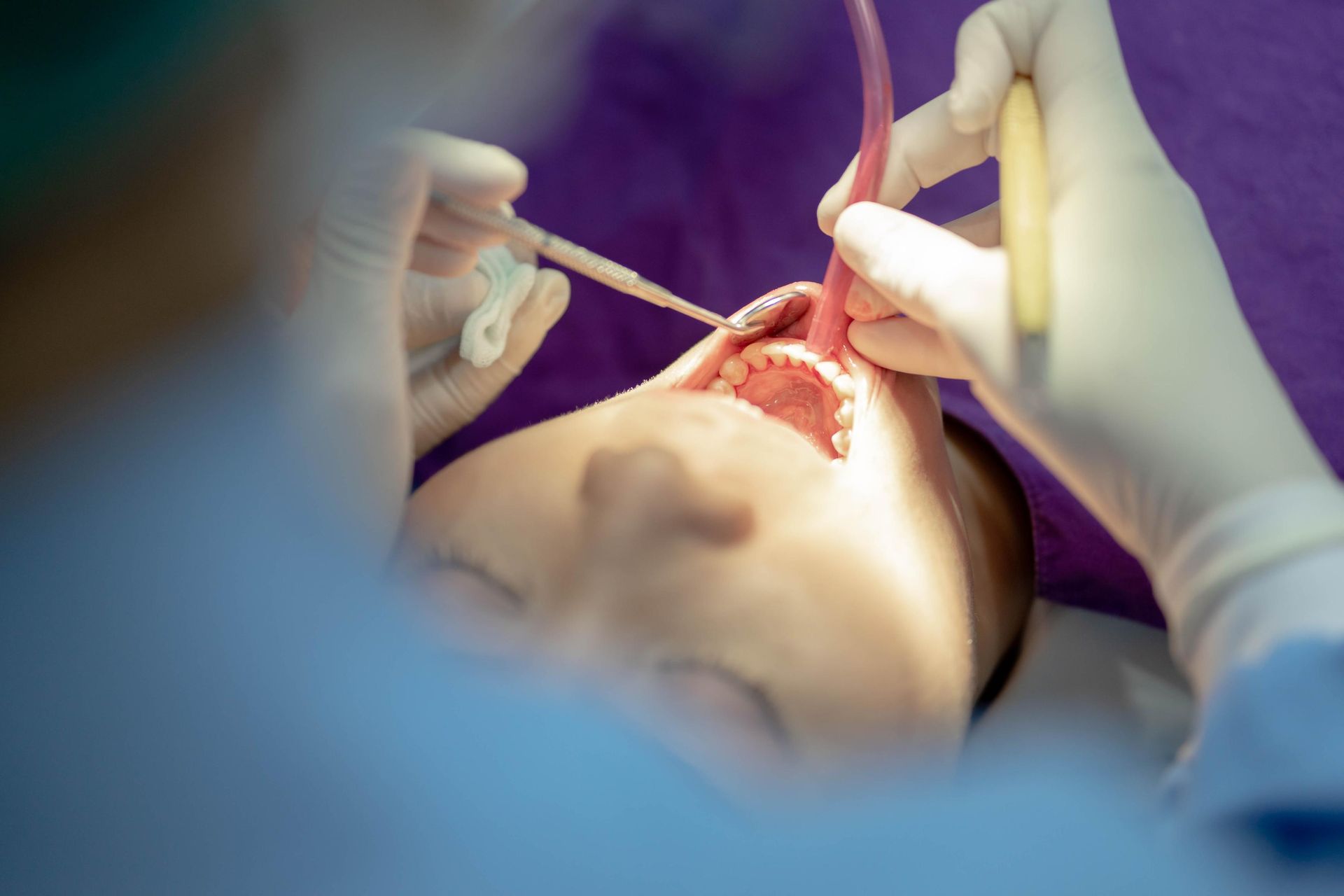 Surgical team performing an oral procedure with gloved hands and tools inside a patient's open mouth