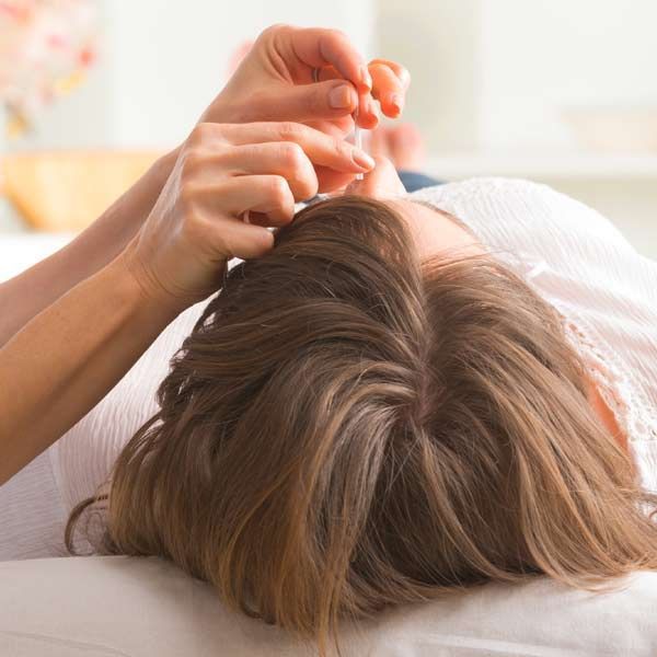 A person getting acupuncture on her head