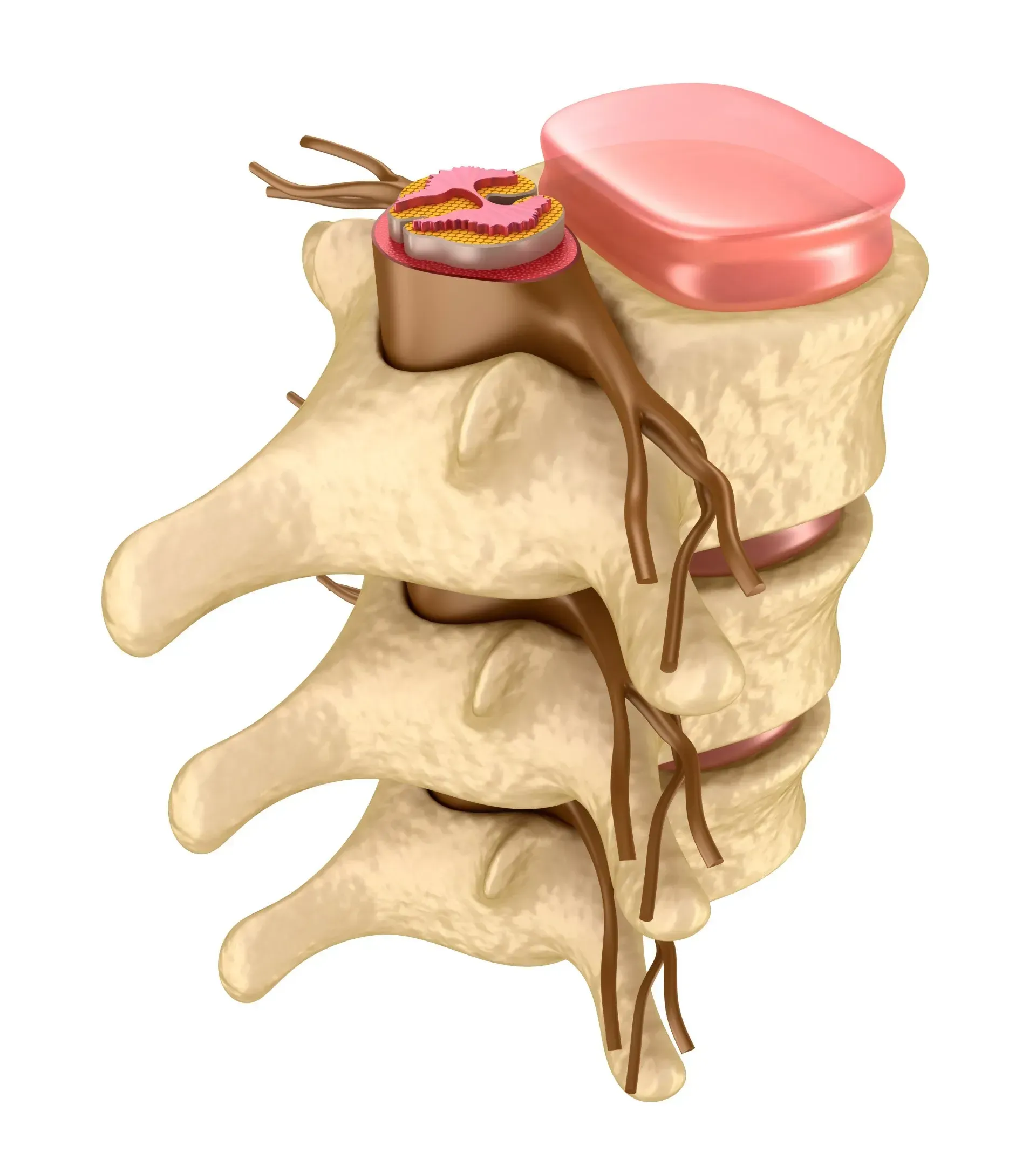 Illustration of a herniated spinal disc compressing nearby nerves in the lower spine
