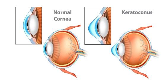 Comparison of a normal cornea and a cornea affected by keratoconus, showing the eye's structure and the cornea's shape.
