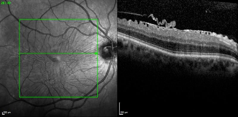 retinal pucker