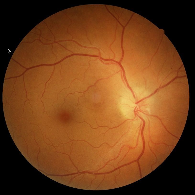 A close up of a person 's eye with optic neuropathy