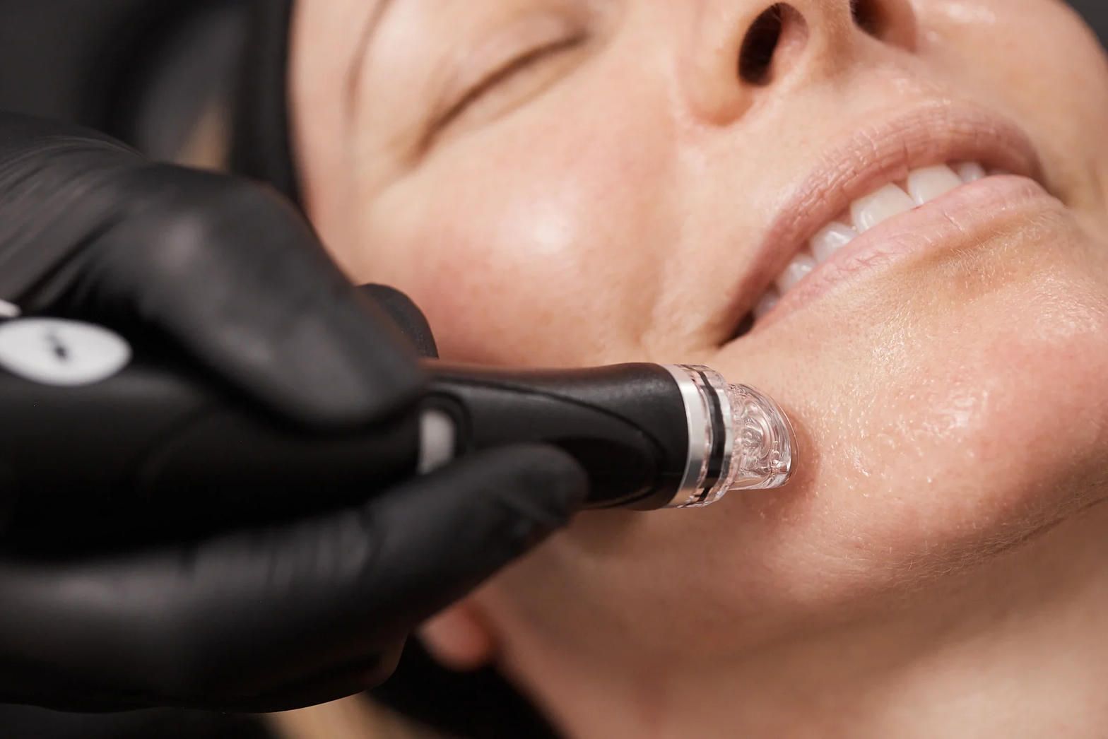 Hydrafacial wand close-up