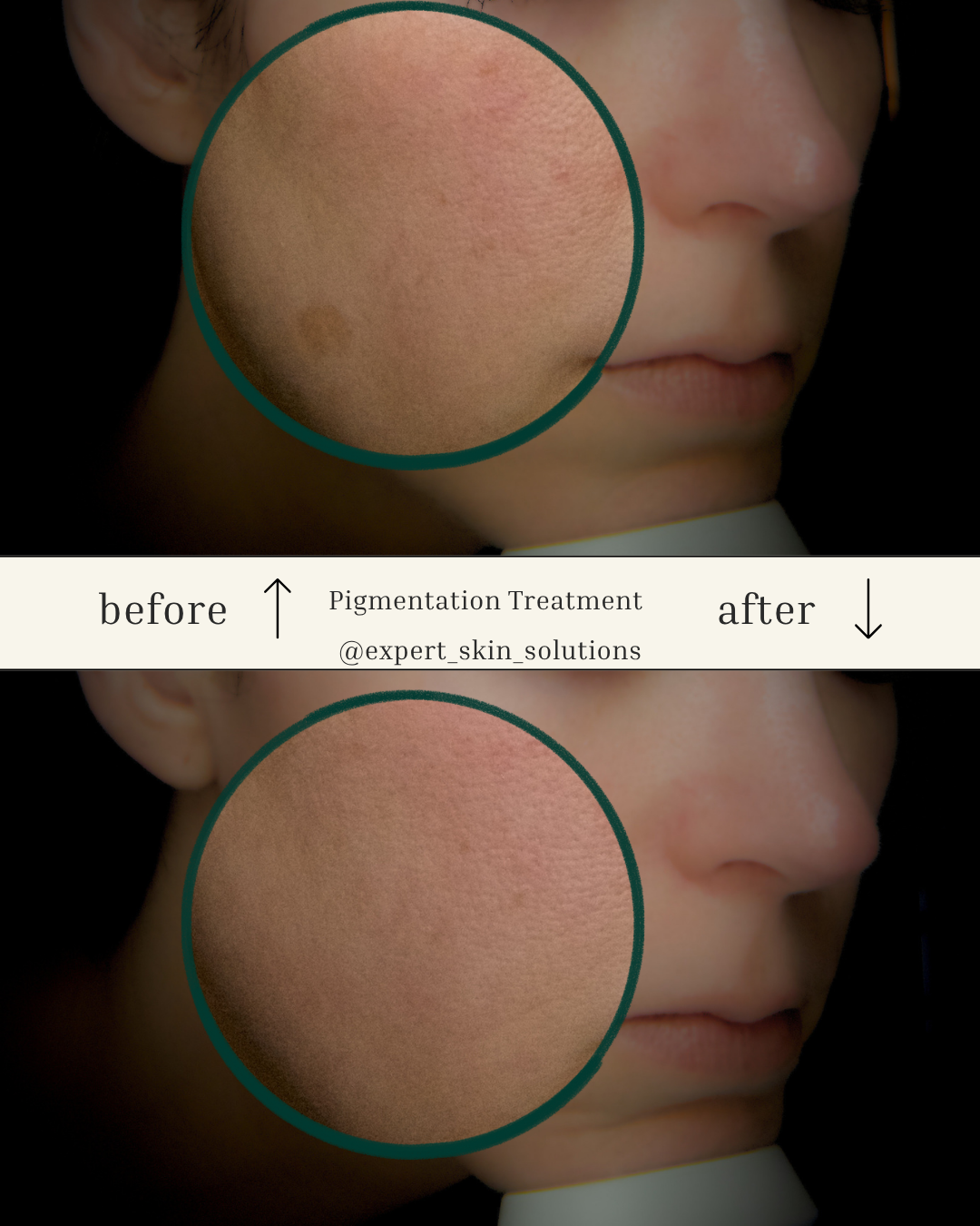 Before and after laser photofacial