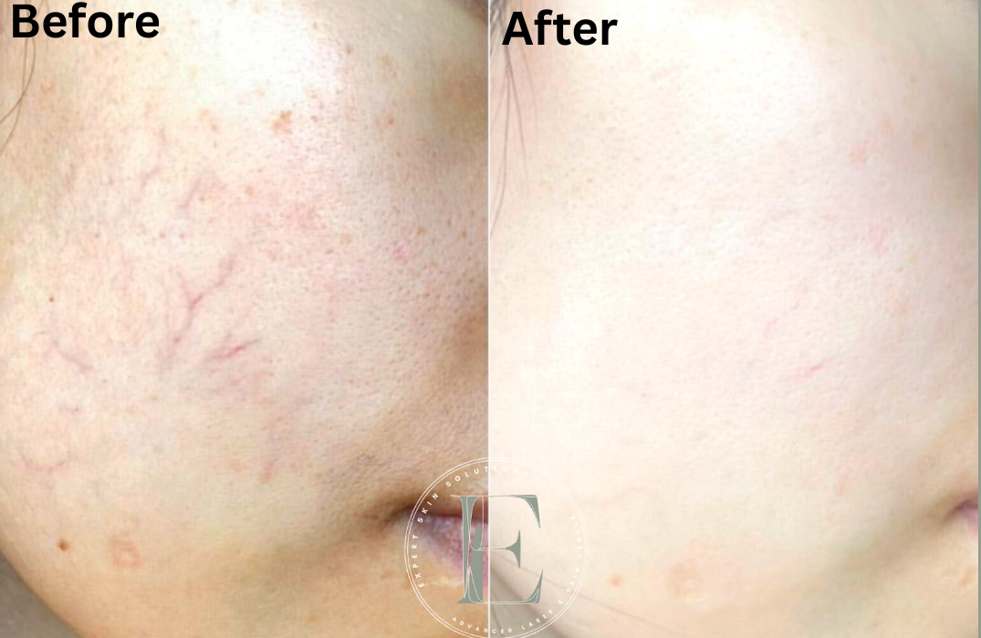 Before and after laser photofacial for broken capillaries