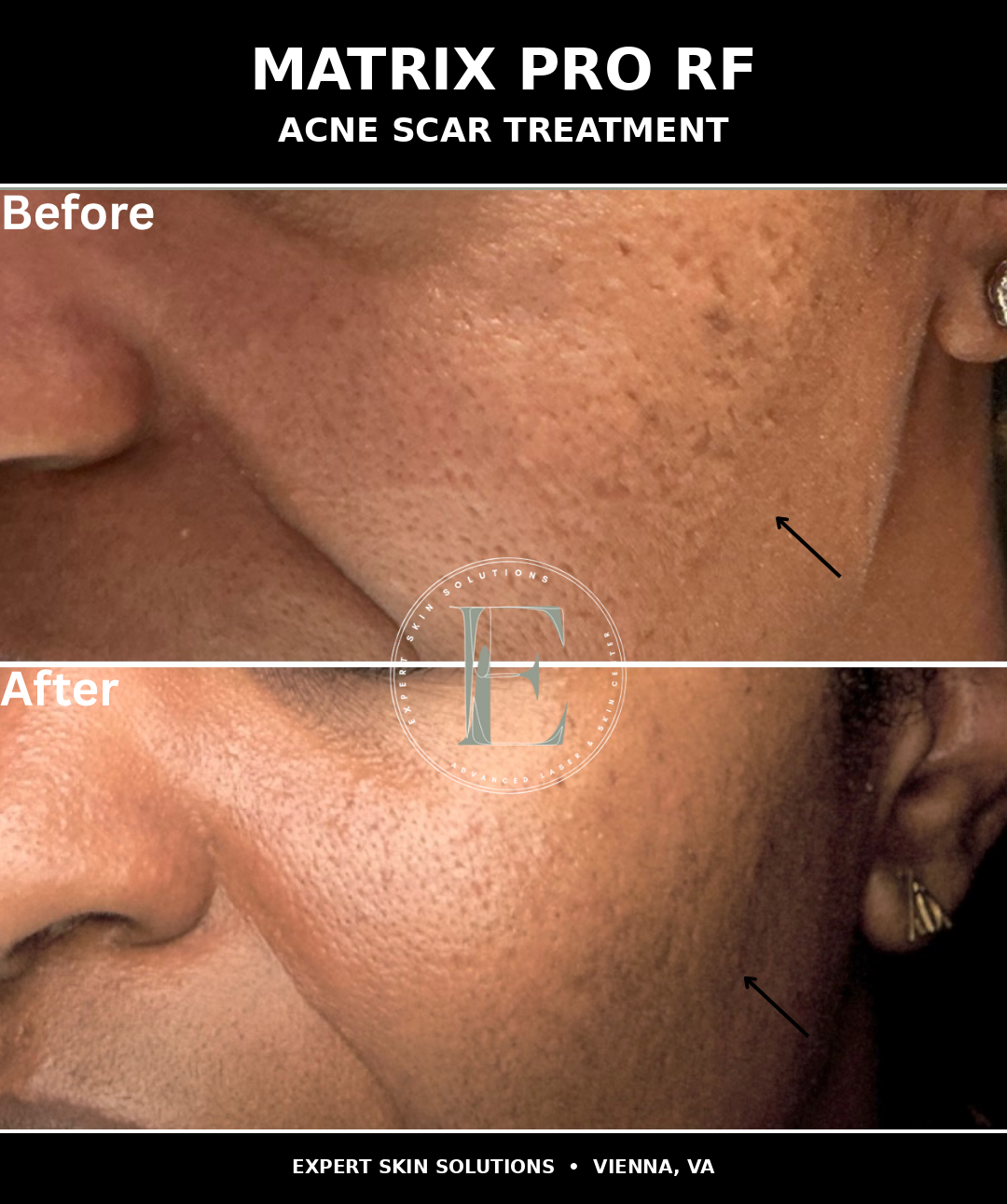 Before and after Matrix RF microneedling