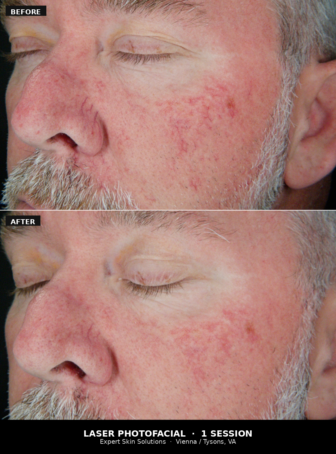 Cross-polarized Nexa skin analysis scan revealing hidden sun damage and pigment