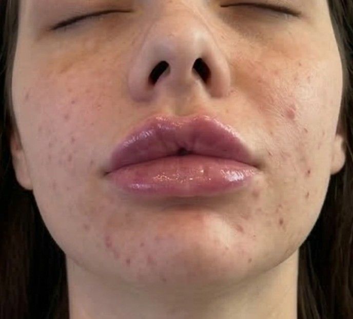 Signature Aesthetics customer following 1ml lip filler treatment