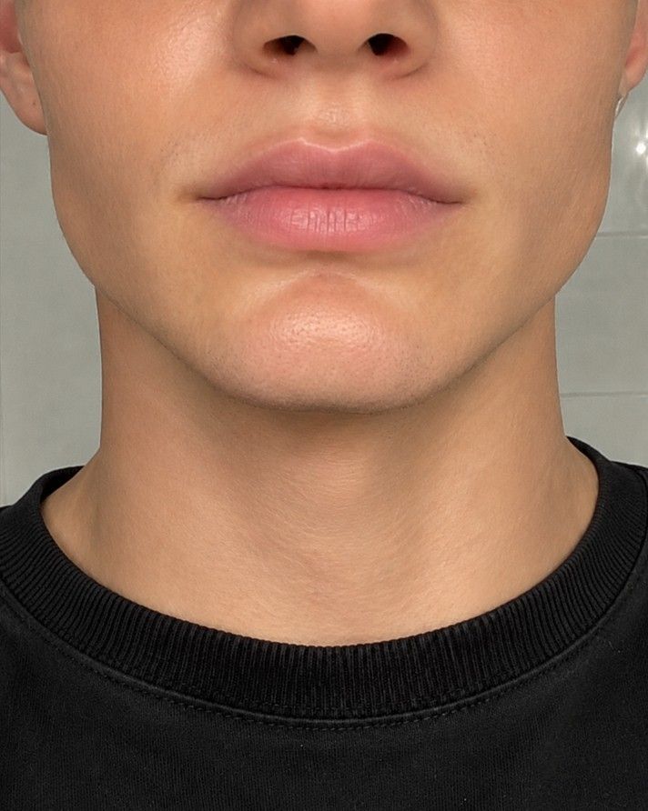 After masseter botox treatment showing slimmer, softer jawline — Signature Aesthetics Nottingham