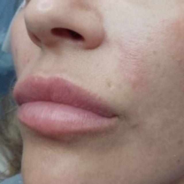 after nasal fold treatment at Signature Aesthetics in Nottingham