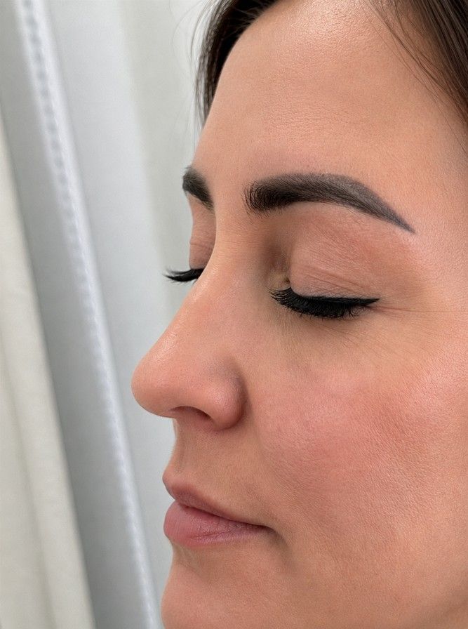 After non-surgical rhinoplasty showing smoother nose profile — Signature Aesthetics Nottingham