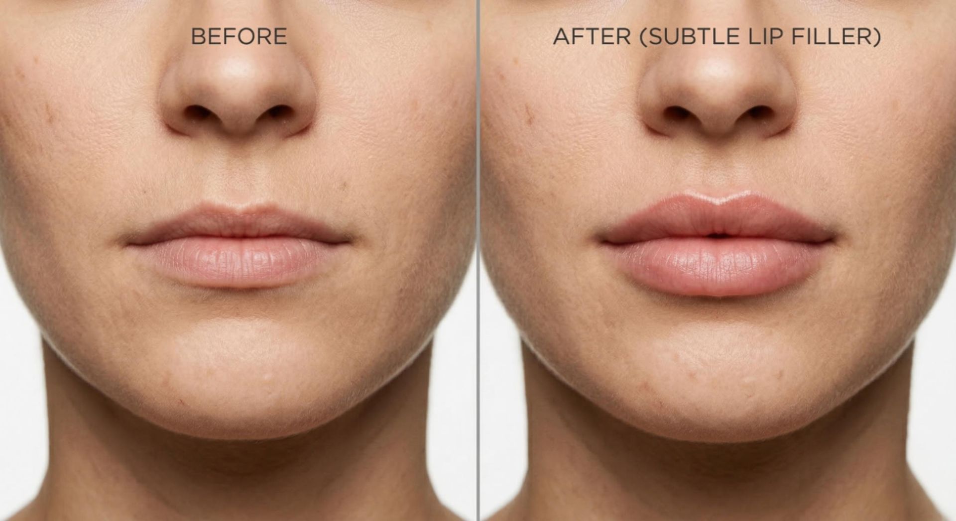 Before and after lip filler comparison showing natural volume enhancement and improved definition at Signature Aesthetics